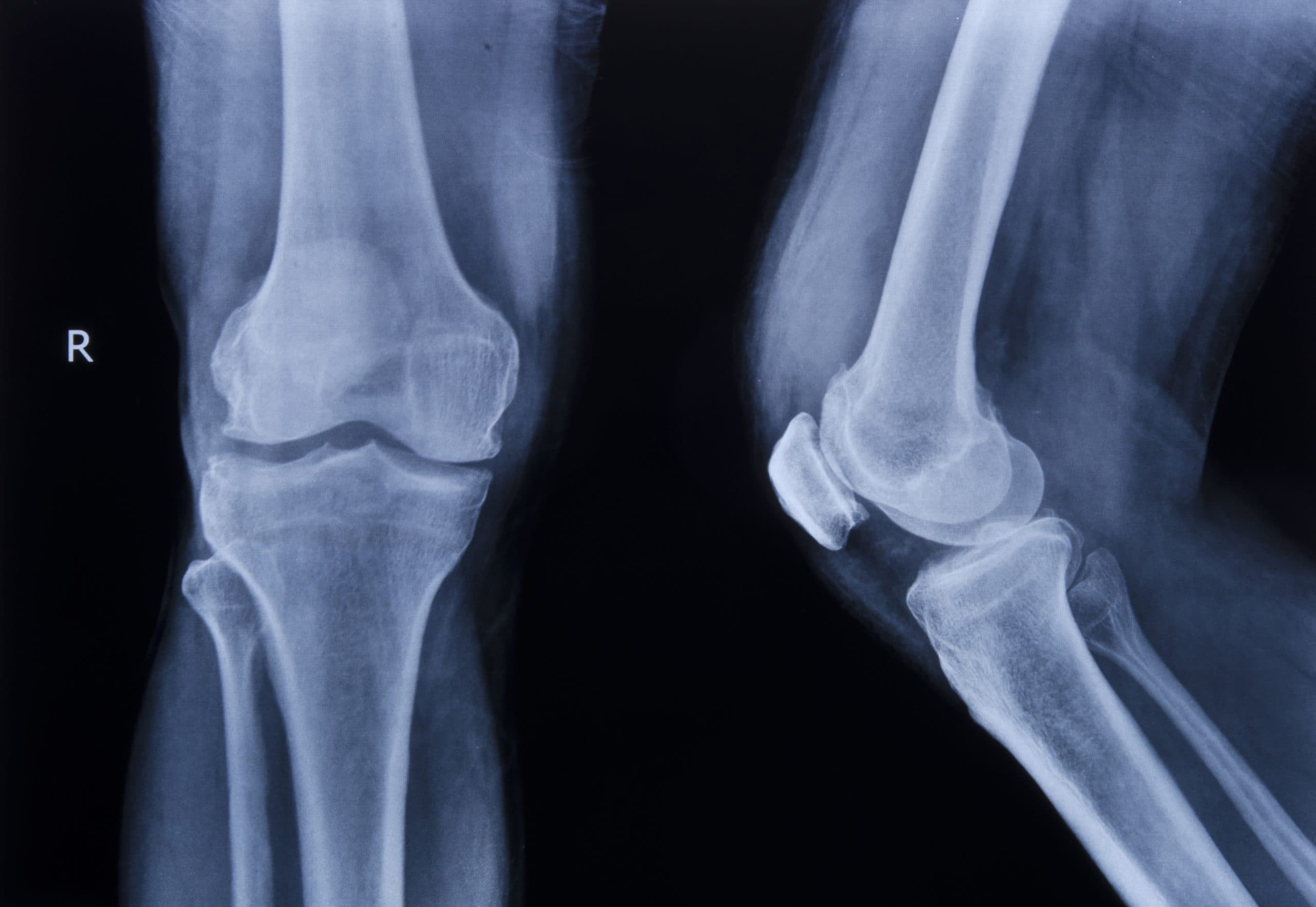 Regenerative cartilage injection prepared at London Cartilage Clinic